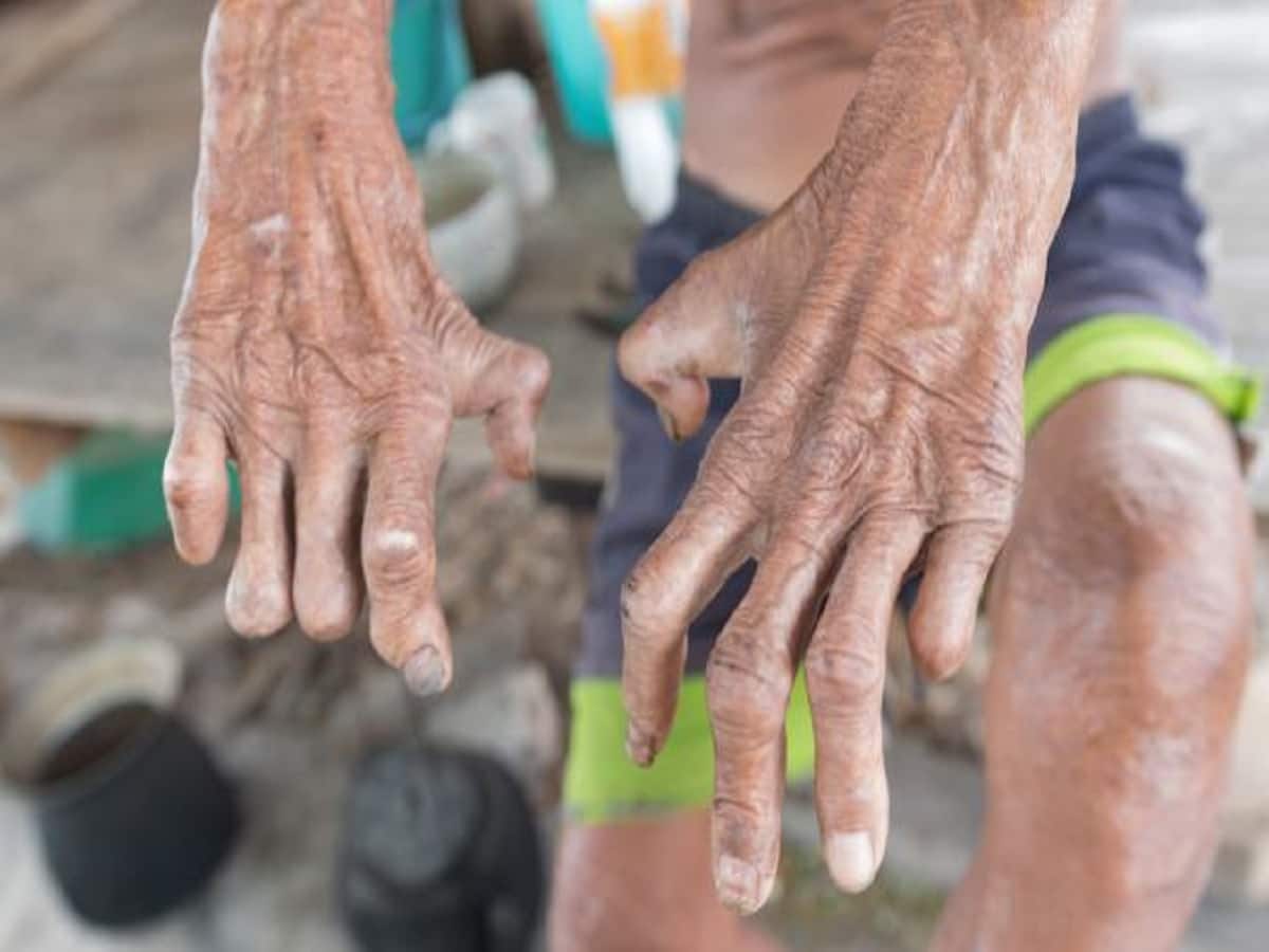 What New Can Be Done To Treat Leprosy?